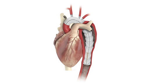 Thoraflex Hybrid Stent Graft from Vascutek